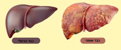 כבד נורמלי לעומת כבד שומני